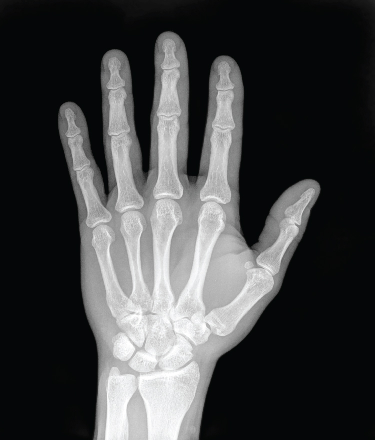 This photo shows an X ray image of the palmar surface of the left hand. The bones appear bright white against a gray outline of the skin of the hand. The four segments of the finger bones are clearly visible, as well as the collection of round bones that compose the wrist and connect the hand to the two bones of the forearm.