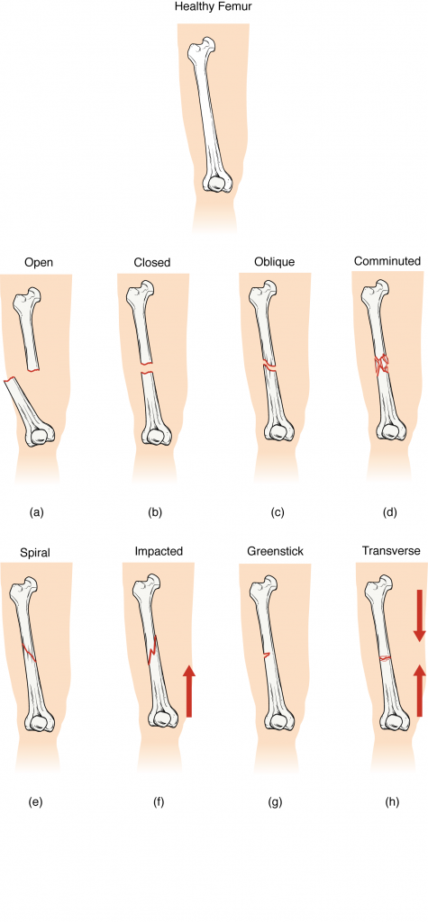 In this illustration, each type of fracture is shown on the right femur from an anterior view. In the closed fracture, the femur is broken in the middle of the shaft with the upper and lower halves of the bone completely separated. However, the two halves of the bones are still aligned in that the broken edges are still facing each other. In an open fracture, the femur is broken in the middle of the shaft with the upper and lower halves of the bone completely separated. Unlike the closed fracture, in the open fracture, the two bone halves are misaligned. The lower half is turned laterally and it has protruded through the skin of the thigh. The broken ends no longer line up with each other. In a transverse fracture, the bone has a crack entirely through its width, however, the broken ends are not separated. The crack is perpendicular to the long axis of the bone. Arrows indicate that this is usually caused by compression of the bone in a superior-inferior direction. A spiral fracture travels diagonally through the diameter of the bone. In a comminuted fracture, the bone has several connecting cracks at its middle. It is possible that the bone could splinter into several small pieces at the site of the comminuted fracture. In an impacted fracture, the crack zig zags throughout the width of the bone like a lightning bolt. An arrow indicates that these are usually caused by an impact that pushes the femur up into the body. A greenstick fracture is a small crack that does not extend through the entire width of the bone. The oblique fracture shown here is travelling diagonally through the shaft of the femur at about a thirty degree angle.