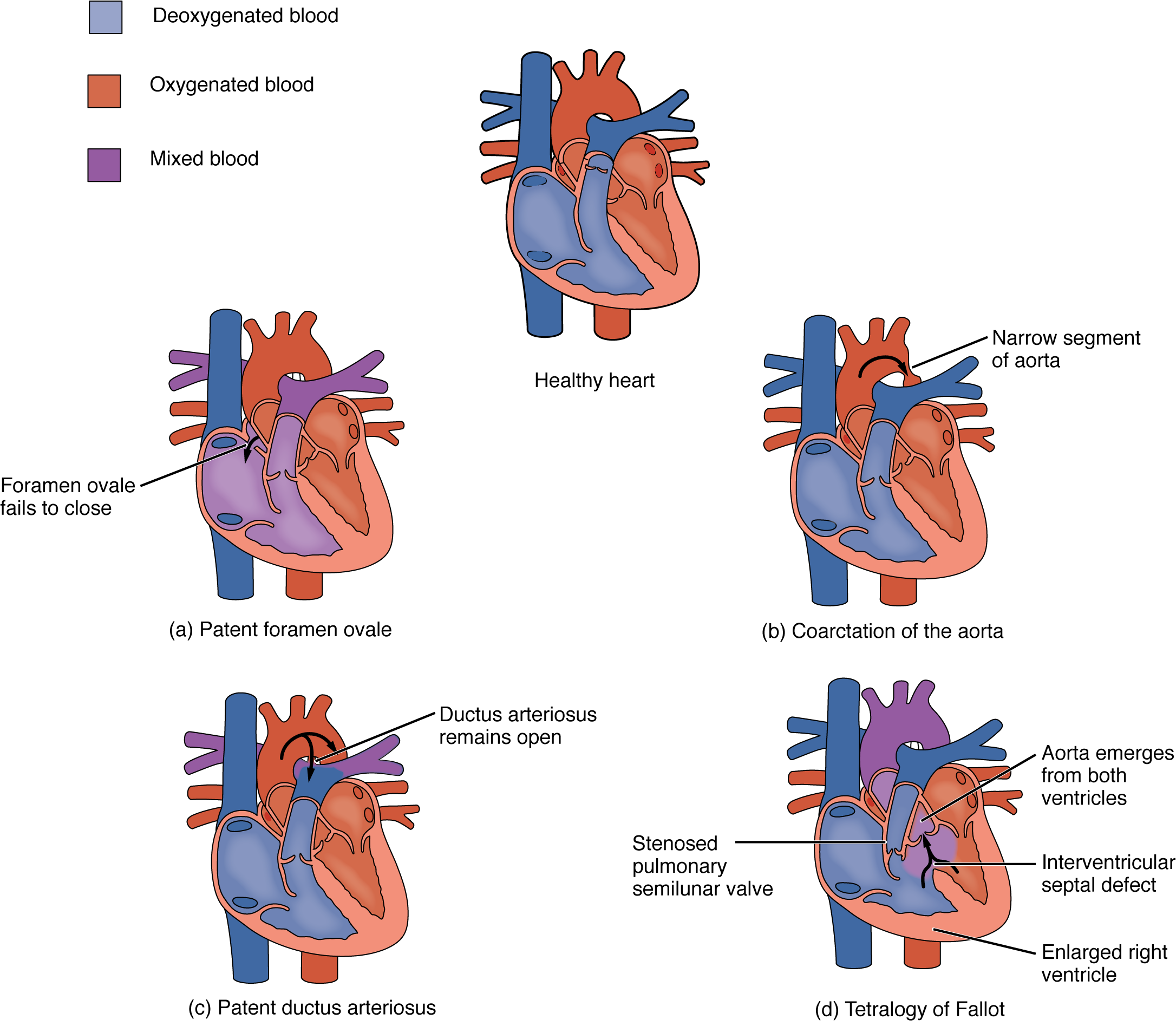 This diagram shows the structure of the heart with different congenital defects. The top left panel shows patent foramen ovale, the top right panel shows coarctation of the aorta, the bottom left panel shows patent ductus ateriosus and the bottom right shows tetralogy of fallot.