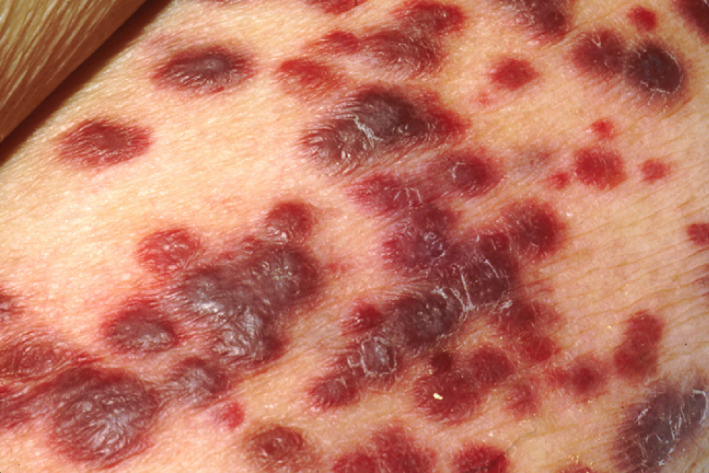 This photograph shows lesions on the surface of skin.