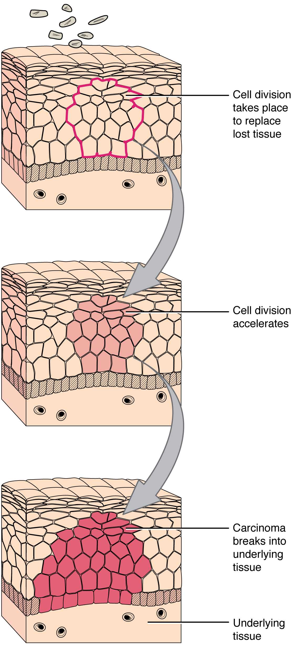 This series of three diagrams shows the development of cancer in epithelial cells. In all three diagrams, layers of epithelial tissue cover a generic underlying tissue. In the first diagram, an injury kills a section of the epithelial cells. In the second image, new epithelial cells have completely filled in the wounded area. However, cell division is still accelerating. In the lowest diagram, the epithelial cells have continued to divide and have now expanded beyond the original wound area. The group of dividing cells, now called a carcinoma, breaks into the layer of underlying tissue.