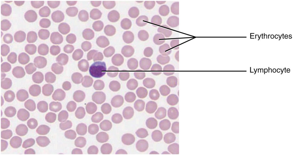 This micrograph of a blood smear shows a group of red blood cells and a single white blood cell. The red cells are small discs which have a slight depression at their centers with no nuclei present. The white blood cell is larger and more darkly stained and has a large, prominent nucleus that is also darkly stained.