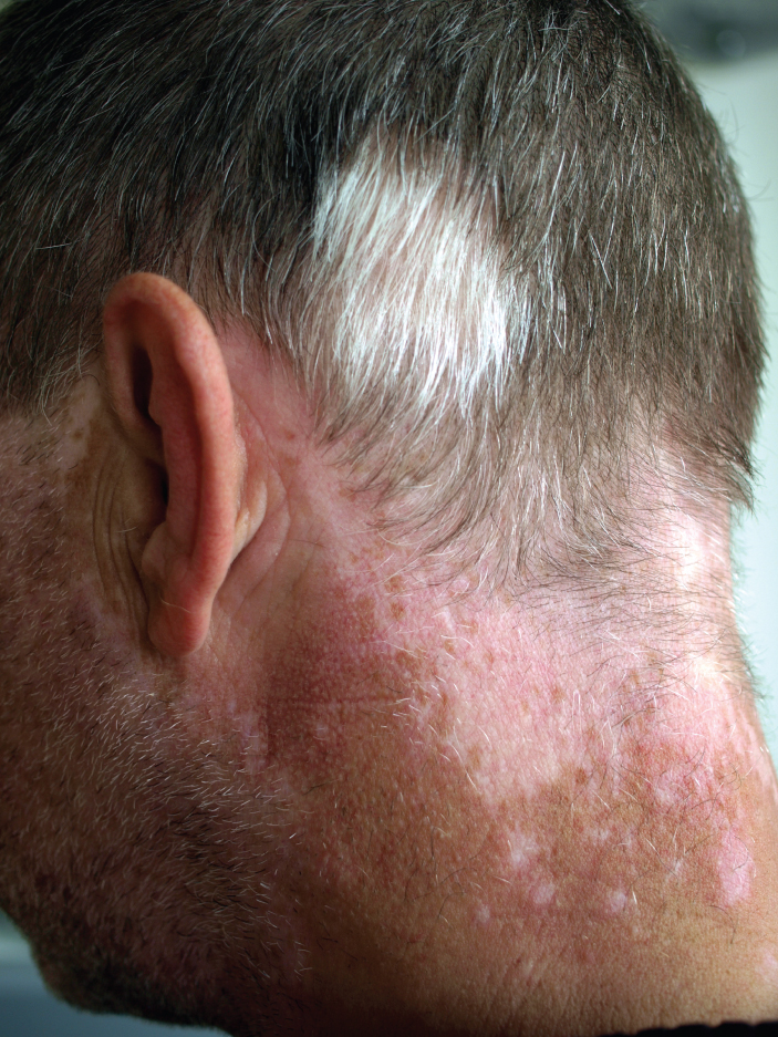 This photo shows the back of a man’s neck. There is a large, discolored patch of skin at the base of his hairline. The discolored area extends over the ears onto the cheeks, toward the front of the face. The man’s head and facial hair are mostly gray, but white patches of hair are seen above the discolored skin.