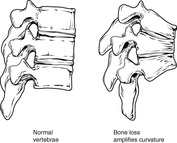 This figure shows the changes to the spine in osteoporosis. The left panel shows the structure of normal vertebrae and the right panel shows the curved vertebrae in osteoporosis.