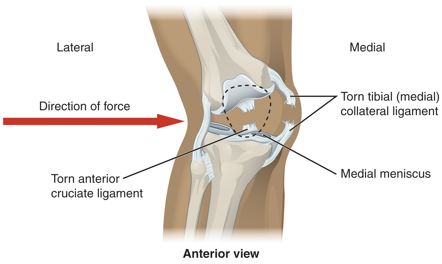 This image shows an injured knee joint. A red arrow points from left to right showing the direction of force that caused the injury.