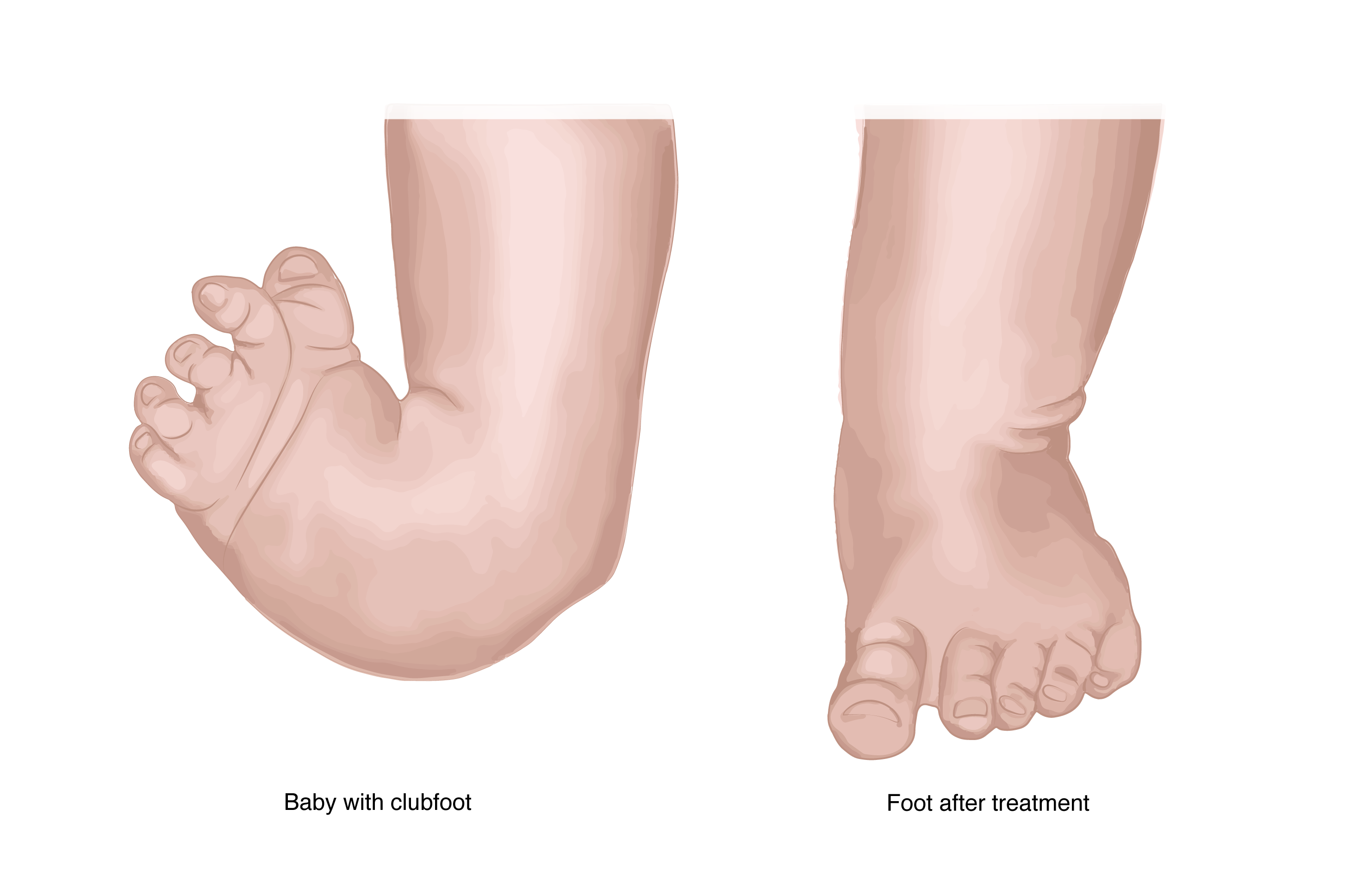 Illustration of a side-by-side view of a clubfoot before and after treatment.
