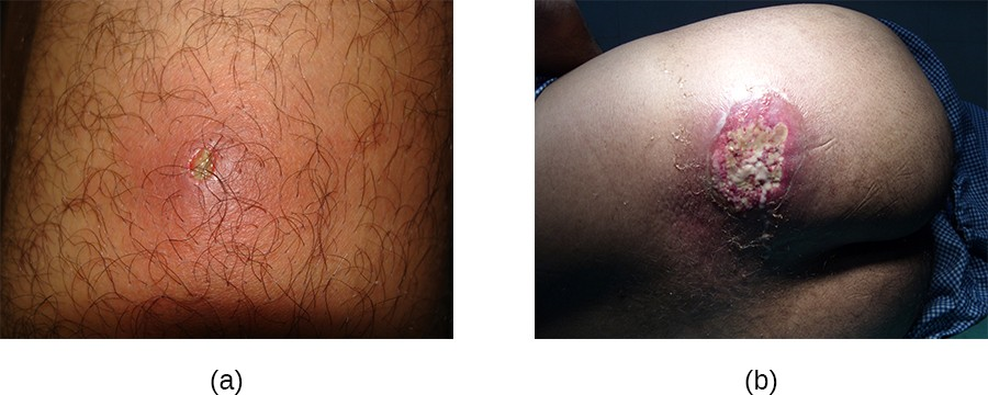 Furuncles (boils) and carbuncles are infections of the skin often caused by Staphylococcus bacteria. (a)  A furuncle contains pus and exhibits swelling. (b) A carbuncle is a pus-filled lesion that is typically deeper than the furuncle. It often forms from multiple furuncles.