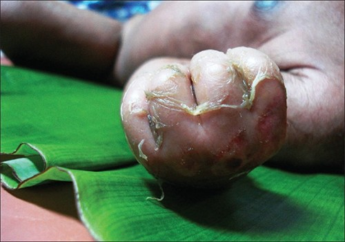 A newborn with staphylococcal scalded skin syndrome (SSSS), which results in large regions of peeling, dead skin.