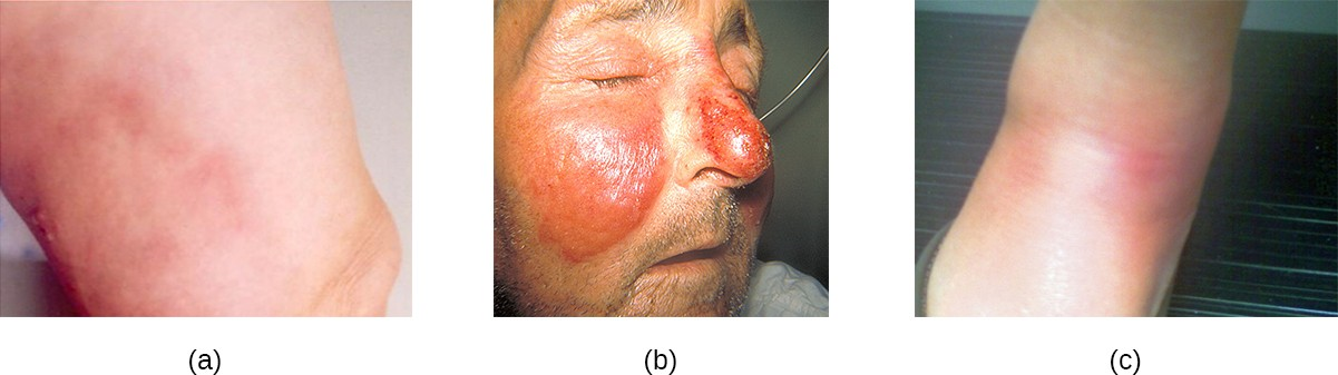 S. pyogenes can cause a variety of skin conditions once it breaches the skin barrier through a cut or wound. (a) Cellulitis presents as a painful, red rash. (b) Erysipelas presents as a raised rash, usually with clear borders. (c) Erythema nodosum is characterized by red lumps or nodules, typically on the lower legs.