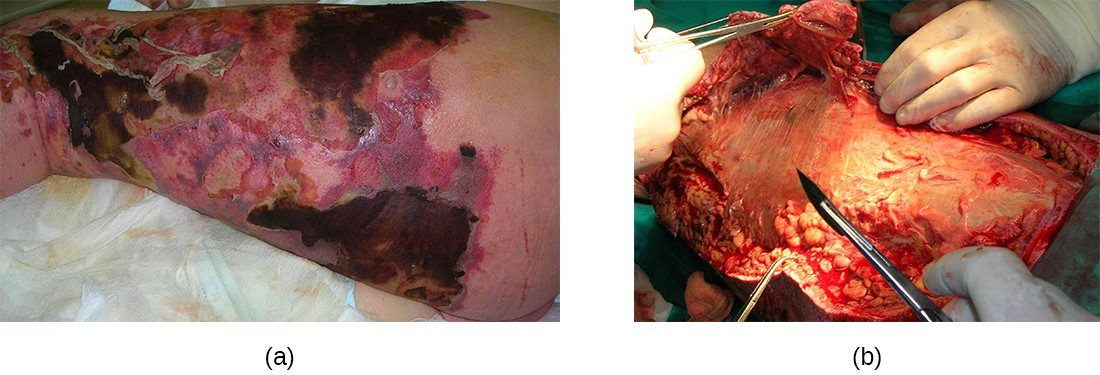 (a) The left leg of this patient shows the clinical features of necrotizing fasciitis. (b) The same patient’s leg is surgically debrided to remove the infection.