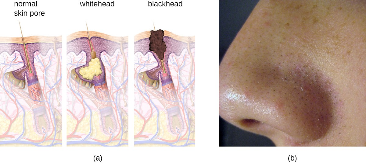 (a) Acne is characterized by whitehead and blackhead comedones that result from clogged hair follicles. (b) Blackheads, visible as black spots on the skin, have a dark appearance due to the oxidation of lipids in sebum via exposure to the air.