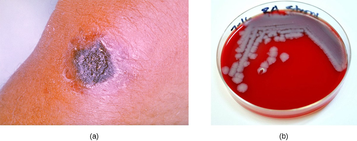 (a) Cutaneous anthrax is an infection of the skin by B. anthracis, which produces tissue-damaging exotoxins. Dead tissues accumulating in this nodule have produced a small black eschar. (b) Colonies of B. anthracis grown on sheep’s blood agar.