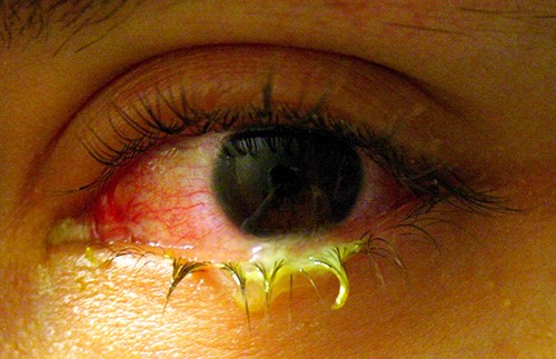 Acute, purulent, bacterial conjunctivitis causes swelling and redness in the conjunctiva, the membrane lining the whites of the eyes and the inner eyelids. It is often accompanied by a yellow, green, or white discharge, which can dry and become encrusted on the eyelashes.