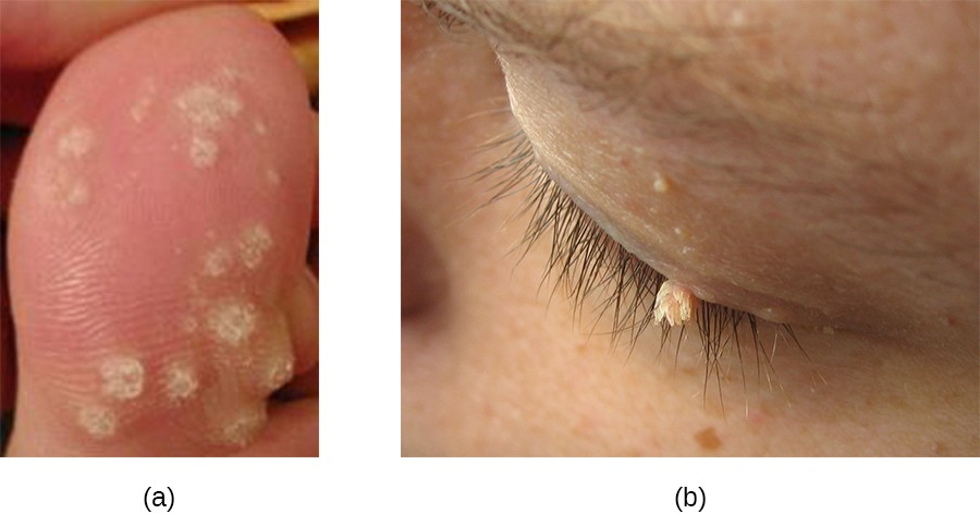 Warts can vary in shape and in location. (a) Multiple plantar warts have grown on this toe. (b) A filiform wart has grown on this eyelid.