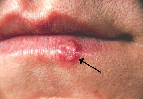 This cold sore was caused by HSV-1.