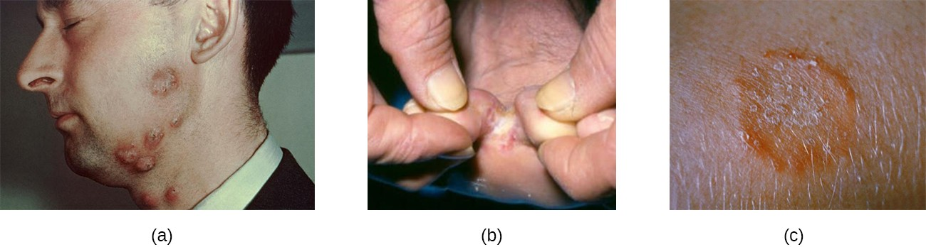 Tineas are superficial cutaneous mycoses and are common. (a) Tinea barbae (barber’s itch) occurs on the lower face. (b) Tinea pedis (athlete’s foot) occurs on the feet, causing itching, burning, and dry, cracked skin between the toes. (c) A close-up view of tinea corporis (ringworm) caused by Trichophyton mentagrophytes.