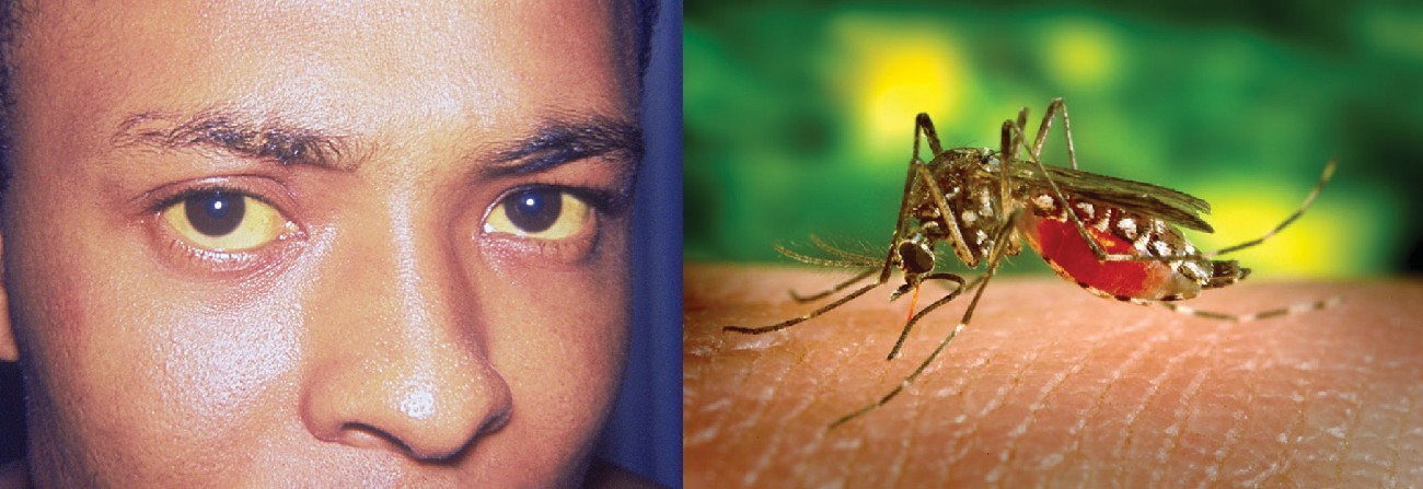 Yellow fever is a viral hemorrhagic disease that can cause liver damage, resulting in jaundice (left) as well as serious and sometimes fatal complications. The virus that causes yellow fever is transmitted through the bite of a biological vector, the Aedes aegypti mosquito (right). (credit left: modification of work by Centers for Disease Control and Prevention; credit right: modification of work by James Gathany, Centers for Disease Control and Prevention)