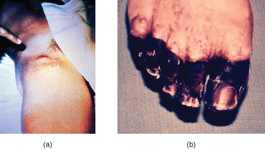 (a) Yersinia pestis infection can cause inflamed and swollen lymph nodes (buboes), like these in the groin of an infected patient. (b) Septicemic plague caused necrotic toes in this patient. Vascular damage at the extremities causes ischemia and tissue death.