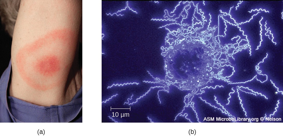 (a) A characteristic bull’s eye rash of Lyme disease forms at the site of a tick bite. (b) A darkfield micrograph shows Borrelia burgdorferi, the causative agent of Lyme disease.