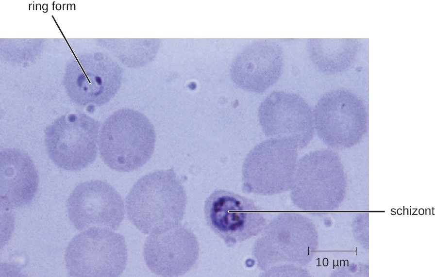 A blood smear (human blood stage) shows an early trophozoite in a delicate ring form (upper left) and an early stage schizont form (center) of Plasmodium falciparum from a patient with malaria.