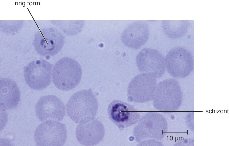 plasmodium falciparum peritoneal fluid