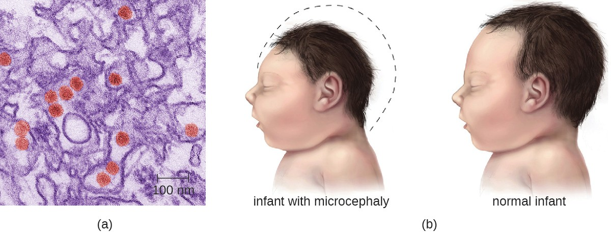 (a) This colorized electron micrograph shows Zika virus particles (red). (b) Women infected by the Zika virus during pregnancy may give birth to children with microcephaly, a deformity characterized by an abnormally small head and brain.