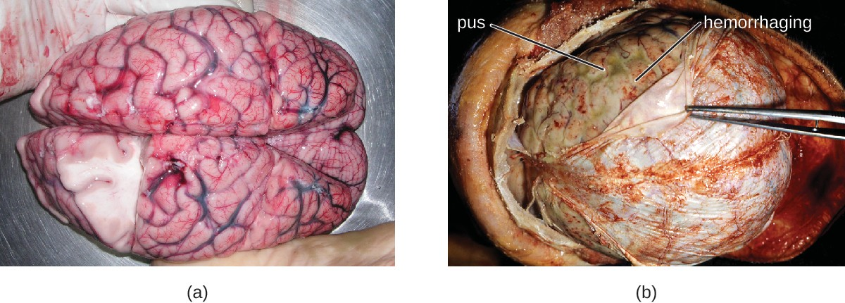 (a) A normal human brain removed during an autopsy. (b) The brain of a patient who died from bacterial meningitis. Note the pus under the dura mater (being retracted by the forceps) and the red hemorrhagic foci on the meninges.