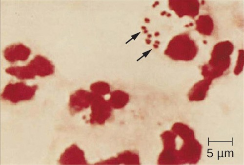 N. meningitidis (arrows) associated with neutrophils (the larger stained cells) in a gram-stained CSF sample.