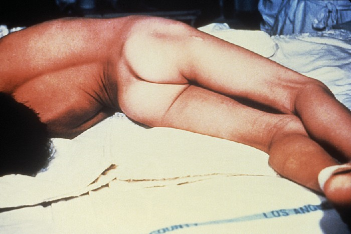 A tetanus patient exhibiting the rigid body posture known as opisthotonos.