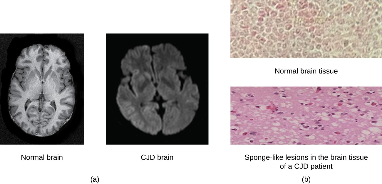 Creutzfeldt-Jakob disease (CJD) is a fatal disease that causes degeneration of neural tissue. (a) These brain scans compare a normal brain to one with CJD. (b) Compared to a normal brain, the brain tissue of a CJD patient is full of sponge-like lesions, which result from abnormal formations of prion protein.