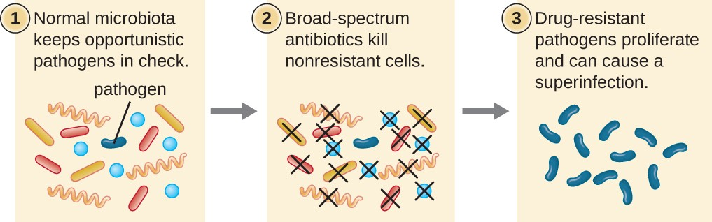 Broad-spectrum antimicrobial use may lead to the development of a superinfection.