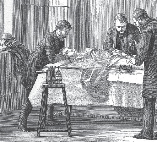 Joseph Lister initiated the use of a carbolic acid (phenol) during surgeries. This illustration of a surgery shows a pressurized canister of carbolic acid being sprayed over the surgical site.