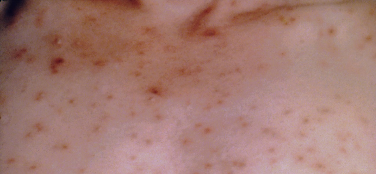 Varicella, or chickenpox, is caused by the highly contagious varicella-zoster virus. The characteristic rash seen here is partly a result of inflammation associated with the body’s immune response to the virus. Inflammation is a response mechanism of innate immunity that helps the body fight off a wide range of infections.