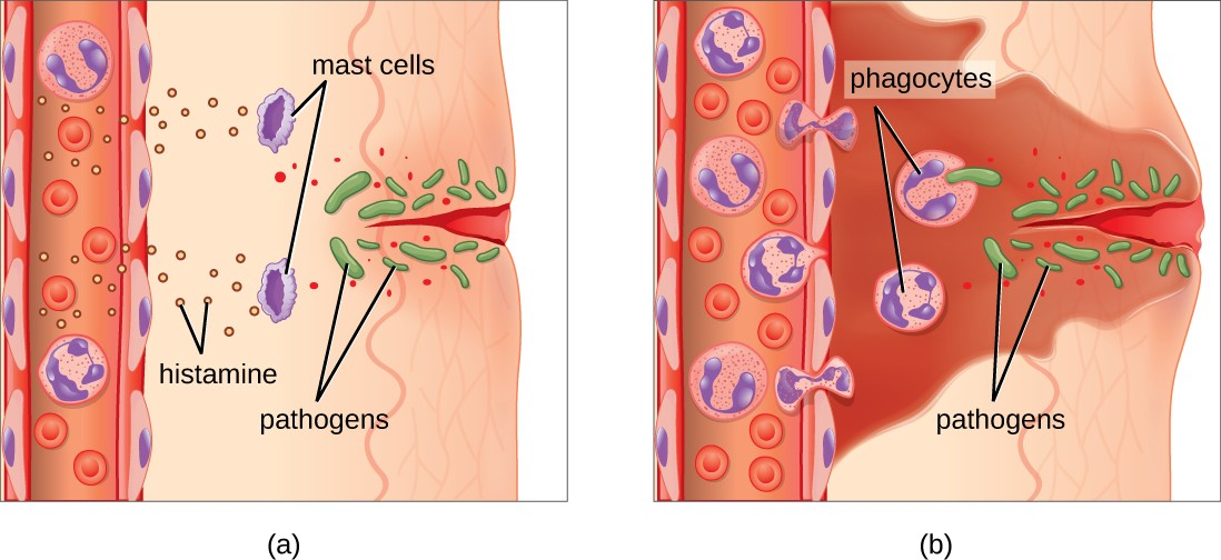 (a) Mast cells detect injury to nearby cells and release histamine, initiating an inflammatory response. (b)  Histamine increases blood flow to the wound site, and increased vascular permeability allows fluid, proteins, phagocytes, and other immune cells to enter infected tissue. These events result in the swelling and reddening of the injured site, and the increased blood flow to the injured site causes it to feel warm. Inflammation is also associated with pain due to these events stimulating nerve pain receptors in the tissue. The interaction of phagocyte PRRs with cellular distress signals and PAMPs and opsonins on the surface of pathogens leads to the release of more proinflammatory chemicals, enhancing the inflammatory response.