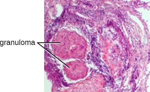 A tubercle is a granuloma in the lung tissue of a patient with tuberculosis. In this micrograph, white blood cells (stained purple) have walled off a pocket of tissue infected with Mycobacterium tuberculosis. Granulomas also occur in many other forms of disease.