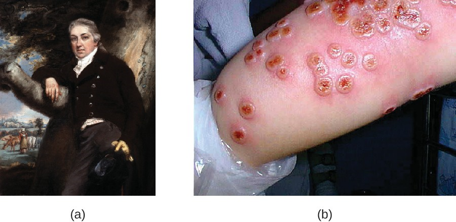 (a) A painting of Edward Jenner depicts a cow and a milkmaid in the background. (b) Lesions on a patient infected with cowpox, a zoonotic disease caused by a virus closely related to the one that causes smallpox.