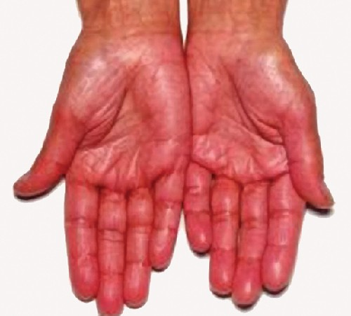 Hyperpigmentation is a sign of Addison disease.