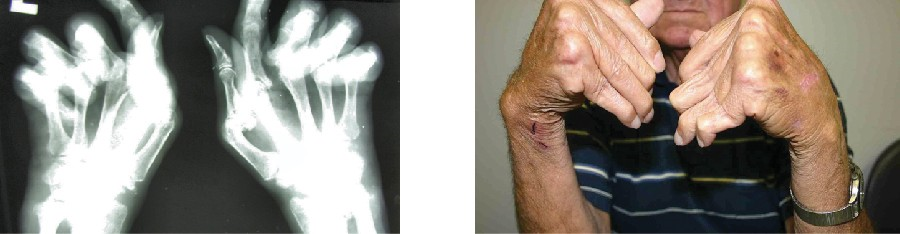 The radiograph (left) and photograph (right) show damage to the hands typical of rheumatoid arthritis.