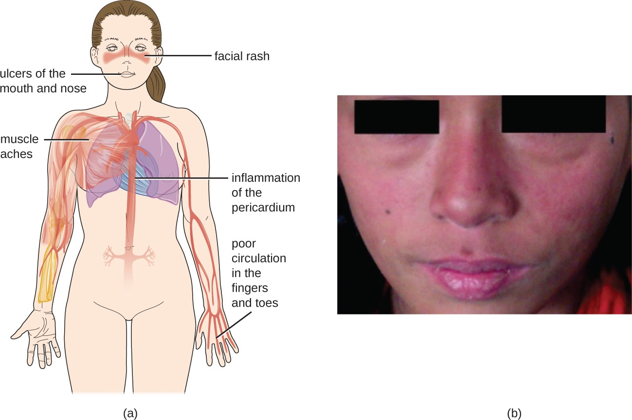 (a) Systemic lupus erythematosus is characterized by autoimmunity to the individual’s own DNA and/ or proteins. (b) This patient is presenting with a butterfly rash, one of the characteristic signs of lupus.