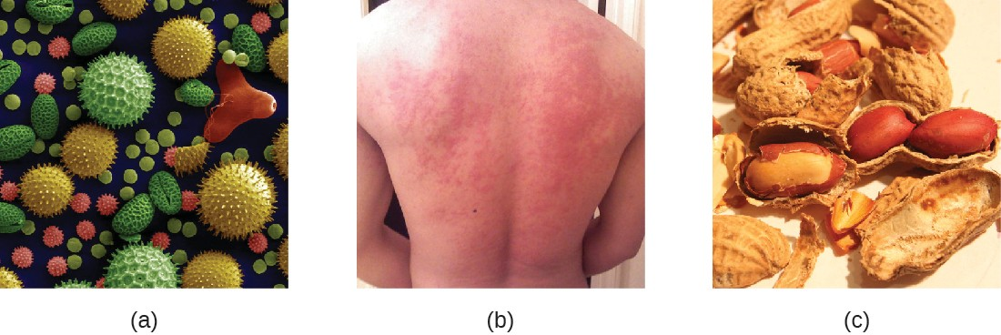 (a) Allergens in plant pollen, shown here in a colorized electron micrograph, may trigger allergic rhinitis or hay fever in sensitive individuals. (b) Skin rashes are often associated with allergic reactions. (c) Peanuts can be eaten safely by most people but can provoke severe allergic reactions in sensitive individuals.
