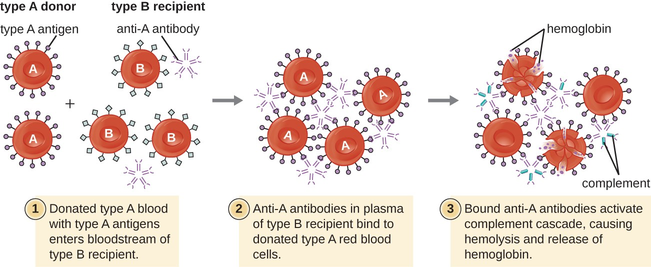 A type II hypersensitivity hemolytic transfusion reaction (HTR) leading to hemolytic anemia. Blood from a type A donor is administered to a patient with type B blood. The anti-A isohemagglutinin IgM antibodies in the recipient bind to and agglutinate the incoming donor type A red blood cells. The bound anti-A antibodies activate the classical complement cascade, resulting in destruction of the donor red blood cells.