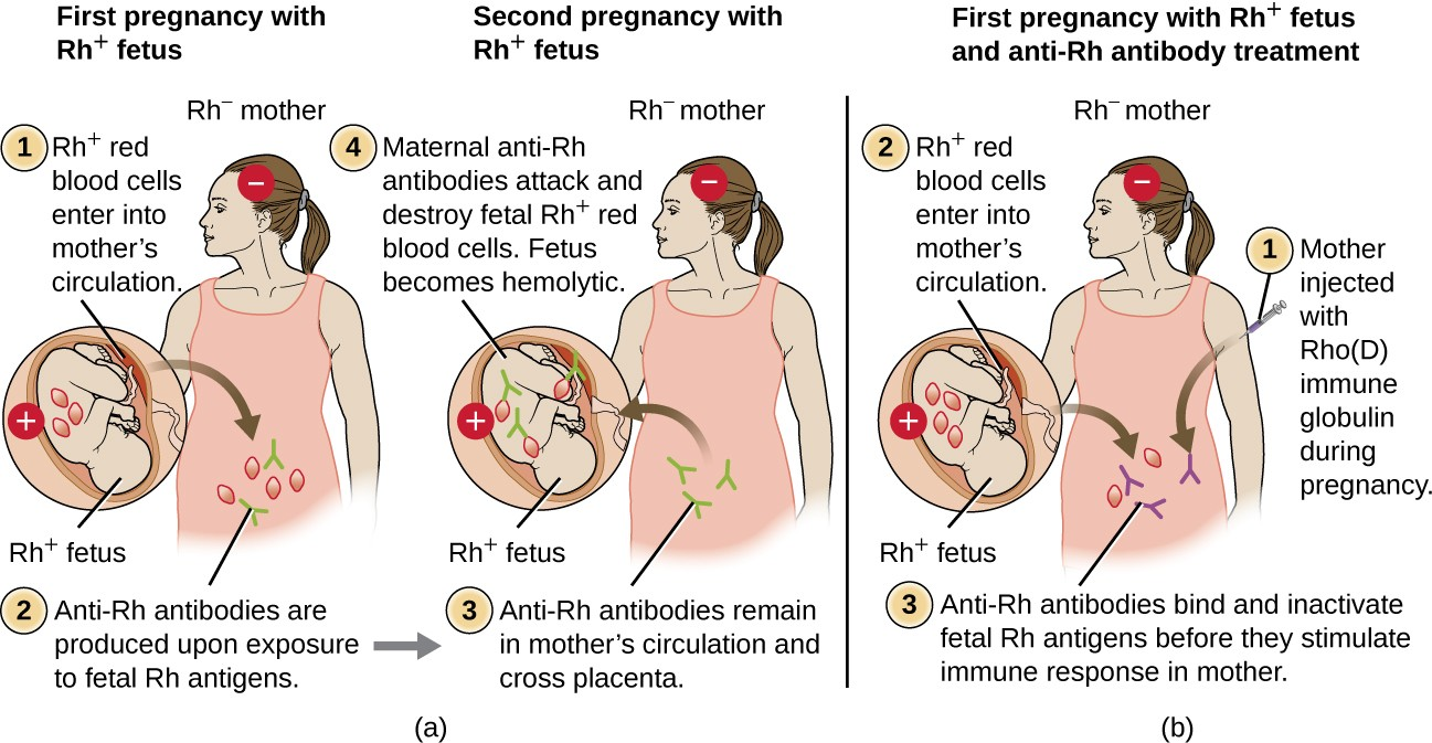(a) When an Rh− mother has an Rh+ fetus, fetal erythrocytes are introduced into the mother ’s circulatory system before or during birth, leading to production of anti-Rh IgG antibodies. These antibodies remain in the mother and, if she becomes pregnant with a second Rh+ baby, they can cross the placenta and attach to fetal Rh+ erythrocytes. Complement-mediated hemolysis of fetal erythrocytes results in a lack of sufficient cells for proper oxygenation of the fetus. (b) HDN can be prevented by administering Rho(D) immune globulin during and after each pregnancy with an Rh+ fetus. The immune globulin binds fetal Rh+ RBCs that gain access to the mother ’s bloodstream, preventing activation of her primary immune response.