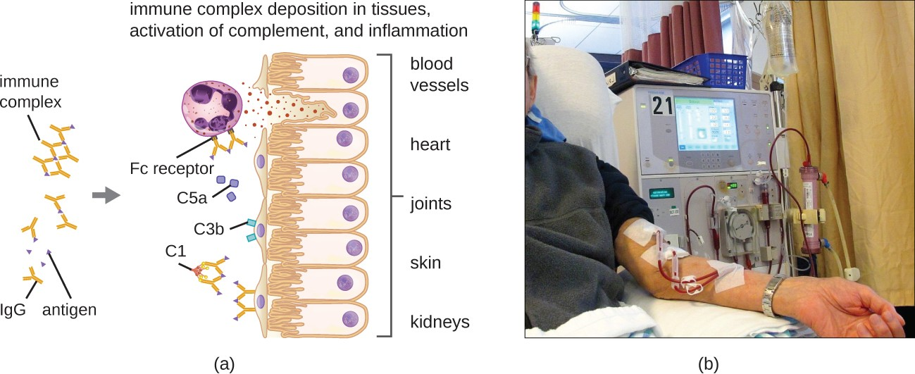 Type III hypersensitivities and the systems they affect. (a) Immune complexes form and deposit in tissue. Complement activation, stimulation of an inflammatory response, and recruitment and activation of neutrophils result in damage to blood vessels, heart tissue, joints, skin, and/or kidneys. (b) If the kidneys are damaged by a type III hypersensitivity reaction, dialysis may be required.