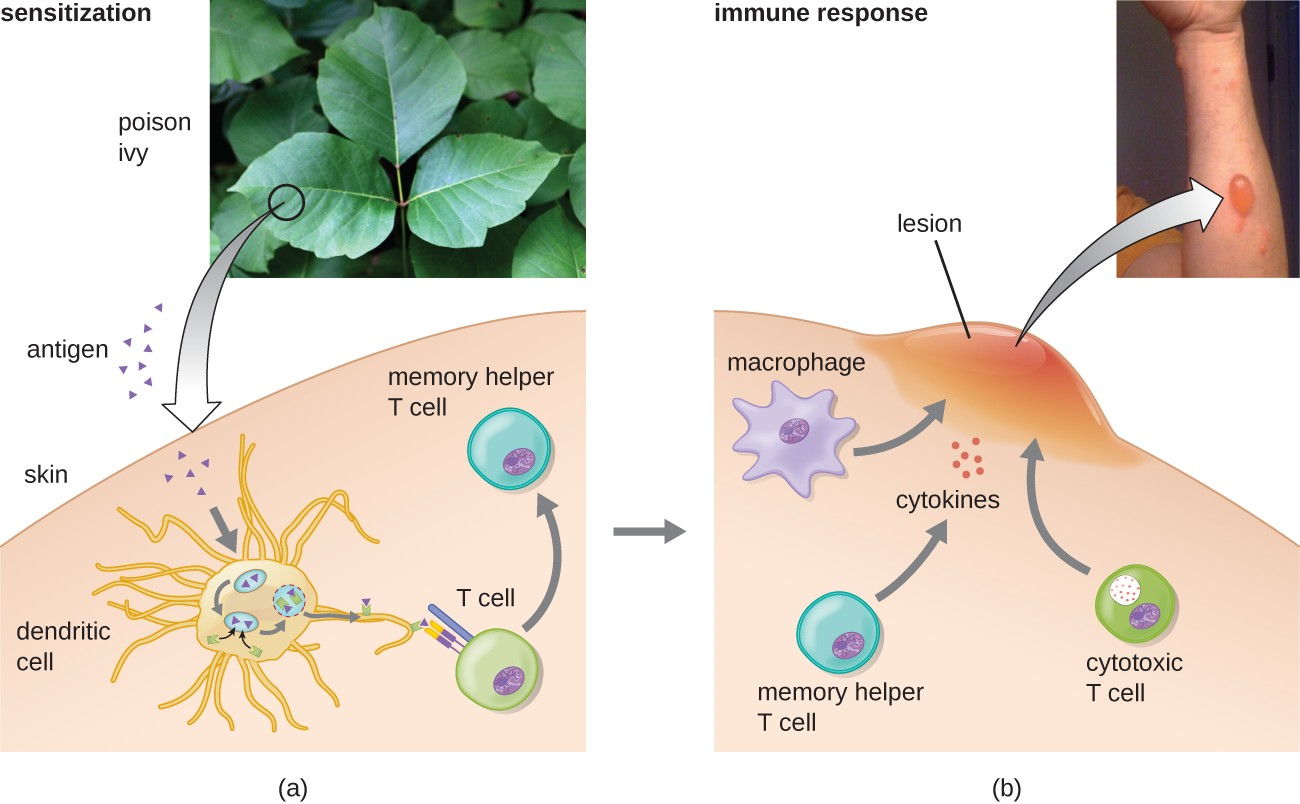 Exposure to hapten antigens in poison ivy can cause contact dermatitis, a type IV hypersensitivity. (a) The first exposure to poison ivy does not result in a reaction. However, sensitization stimulates helper T cells, leading to production of memory helper T cells that can become reactivated on future exposures. (b) Upon secondary exposure, the memory helper T cells become reactivated, producing inflammatory cytokines that stimulate macrophages and cytotoxic T cells to induce an inflammatory lesion at the exposed site. This lesion, which will persist until the allergen is removed, can inflict significant tissue damage if it continues long enough.