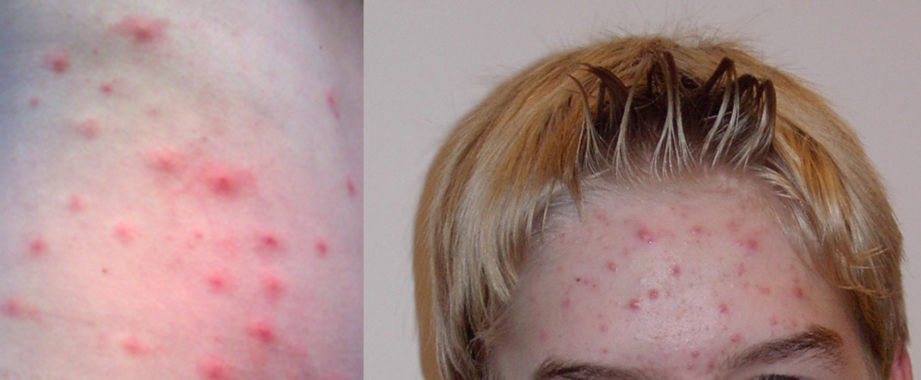 The skin is an important barrier to pathogens, but it can also develop infections. These raised lesions (left) are typical of folliculitis, a condition that results from the inflammation of hair follicles. Acne lesions (right) also result from inflammation of hair follicles. In this case, the inflammation results when hair follicles become clogged with complex lipids, fatty acids, and dead skin cells, producing a favorable environment for bacteria.