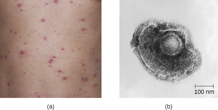 (a) The characteristic appearance of the pustular chickenpox rash is concentrated on the trunk region. (b)  This transmission electron micrograph shows a viroid of human herpesvirus 3, the virus that causes chickenpox in children and shingles when it is reactivated in adults.