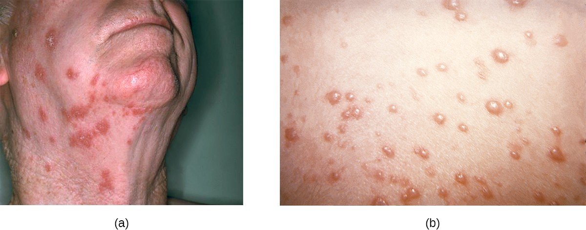 (a) An individual suffering from shingles. (b) The rash is formed because of the reactivation of a varicella-zoster infection that was initially contracted in childhood.