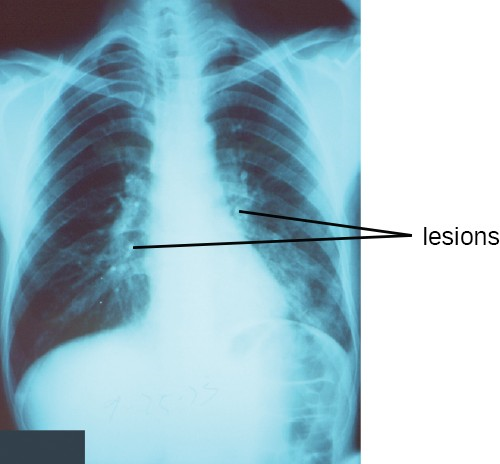 A chest radiograph of a patient with pneumonia shows the consolidations (lesions) present as opaque patches.