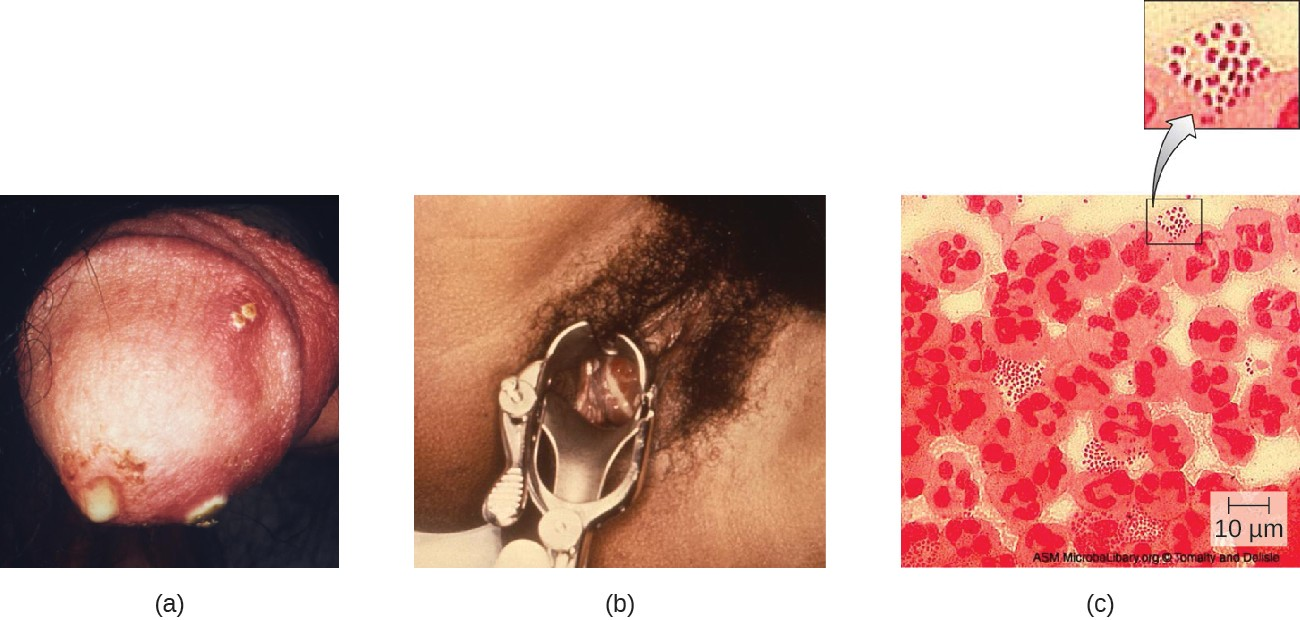 (a) Clinical photograph of gonococcal discharge from penis. The lesions on the skin could indicate co- infection with another STI. (b) Purulent discharge originating from the cervix and accumulating in the vagina of a patient with gonorrhea. (c) A micrograph of urethral discharge shows gram-negative diplococci (paired cells) both inside and outside the leukocytes (large cells with lobed nuclei). These results could be used to diagnose gonorrhea in a male patient, but female vaginal samples may contain other Neisseria spp. even if the patient is not infected with N. gonorrhoeae.