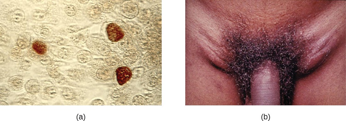 (a) Chlamydia trachomatis inclusion bodies within McCoy cell monolayers. Inclusion bodies are distinguished by their brown color. (b) Lymphogranuloma venereum infection can cause swollen lymph nodes in the groin called buboes.